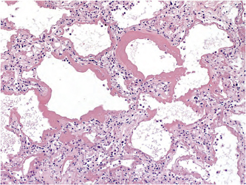 FIGURE WO-5 Lung tissues infected with 2009-H1N1 influenza A show evidence of diffuse alveolar damage, the physical manifestation of acute respiratory distress syndrome.