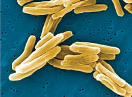 FIGURE WO-4-3 Multidrug-resistant tuberculosis.