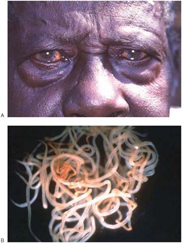 FIGURE WO-6-15 Onchocerciasis. (A) The face of a 63-year-old male farmer, virtually blind, his eyes indicating the ocular damage that occurs as a result of long-term infection (Kanungu district). (B) Mature adult worms (Onchocerca volvulus).