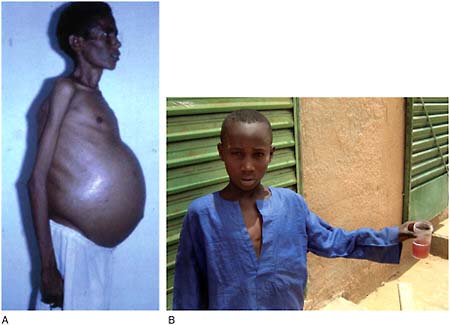 FIGURE WO-6-17 Schistosomiasis. (A) Symptoms of advanced schistosomiasis (distended abdomen and muscle wasting). (B) A child suffering from schistosoma haematobium showing bloody urine—a symptom of chronic infection, Niger.