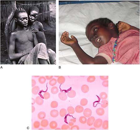 FIGURE WO-6-21 Human African Trypanosomiasis (Trypanosoma brucei). (A) A young woman watches over her husband who is comatose, suffering from sleeping sickness. (B) Child suffering from convulsion due to treatment toxicity, Democratic Republic of Congo. (C) Trypanosoma parasite in peripheral blood.
