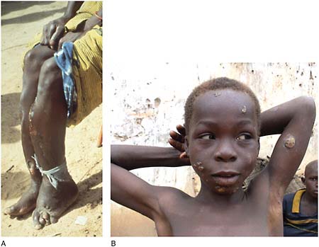 FIGURE WO-6-22 Yaws infection (Treponema pertenue). (A) Tibial “saber” deformity as a result of yaws. (B) Child presenting lesions caused by yaws, Côte d’Ivoire, 2009.