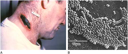 FIGURE WO-6-1 Anthrax. (A) Cutaneous anthrax lesion on neck. (B) Bacterium, Bacillus anthracis, the causative agent of anthrax.