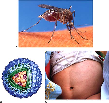 FIGURE WO-6-9 Dengue. (A) Aedes aegypti mosquito, seen feeding on a human host, is the primary peridomestic vector for dengue virus (IOM, 2010). (B) 3D electron microscopy reconstruction of a mature dengue virus. Part of the external glycoprotein shell (blue) and lipid membrane envelope (green) has been cut away to show the internal RNA nucleocapsid (red). (C) Infant with dengue rash—Cambodia.
