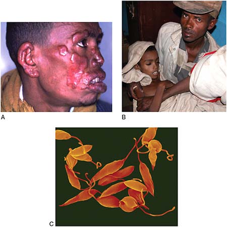 FIGURE WO-6-12 Leishmaniasis (Leishmania). (A) Patient with diffuse cutaneous leishmaniasis. (B) Patient awaiting treatment during a 2005 leishmaniasis outbreak in Libo Kemkem, Highlands, Ethiopia. (C) Parasitic promastigotes that cause leishmaniasis in humans (Leishmania donovani).