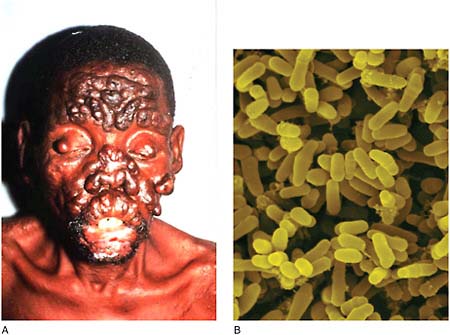 FIGURE WO-6-13 Leprosy (Mycobacterium leprae). (A) The face of a patient with active, neglected nodulous lepromatous leprosy. (B) Mycobacterium leprae—Gram-positive rod prokaryote, cause of leprosy.