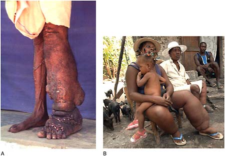 FIGURE WO-6-14 Lymphatic filariasis. (A) A patient with elephantiasis of the left leg. (B) Woman suffering from lymphatic filariasis presenting important bilateral lymphedema, Haiti.